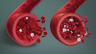 <span class="mw-page-title-main">Hypoglycemia</span> Decrease in blood sugar