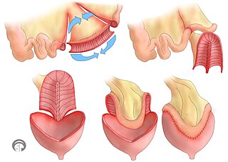 <span class="mw-page-title-main">Bladder augmentation</span>