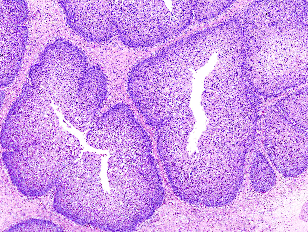 Papilloma della vescica Carcinoma della vescica: chirurgia papilloma skin pathology