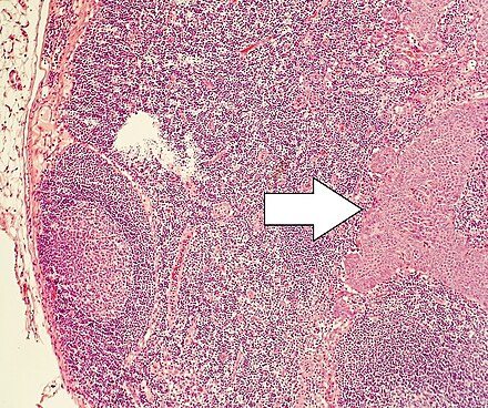 Lymph node metastasis of a neuroendocrine tumour.