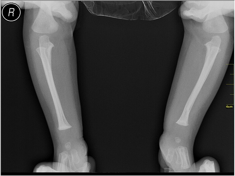 File:Medical X-Ray imaging PHF06 nevit.jpg