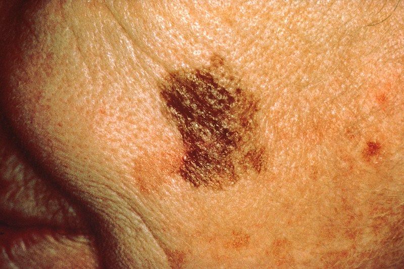 File:Melanoma with diameter change.jpg