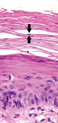 Thumbnail for Parakeratosis