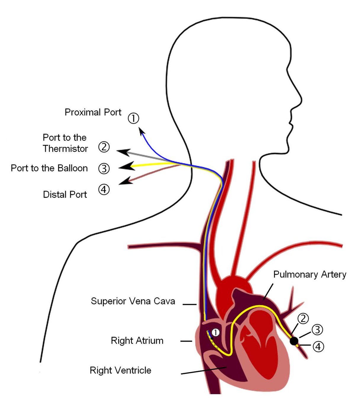 tahikardija, hipertenzija, kratkoća daha lijevi ventrikularni tlak i aorte se