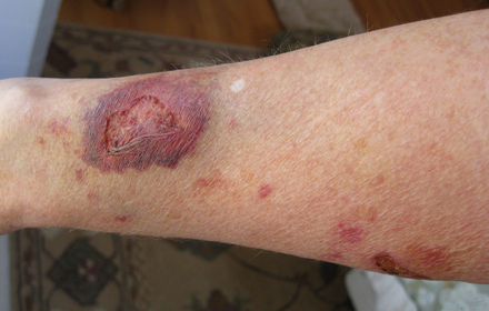 Lower arm of a 47-year-old female showing skin damage caused by topical corticosteroid use