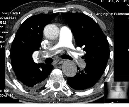 A CT pulmonary angiogram image generated by a computer from a collection of x-rays