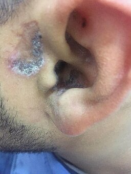 Shuster sign of discoid lupus ertherymatouses