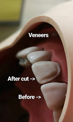 Veneer preparation.jpg