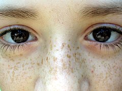 Freckles: What They Are, vs. Moles, Causes & Removal