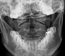 2. Cervical spine x-ray (odontoid view) X-ray of the cervical spine of a 20 year old male - odontoid.jpg