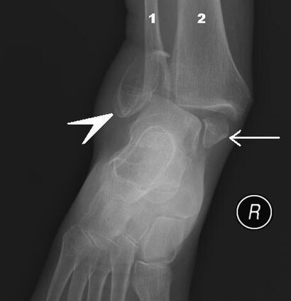 Bimalleolar fracture legend.jpg