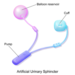 Artificial urinary sphincter.
