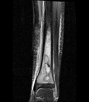 Coronal fat suppressed STIR image showing, bone marrow and subcutaneous edema as well as subperiosteal edema. The thin hypointense rim surrounding the intramedullary collection represents the reactive interface between the abscess and the body's attempt to wall it off.