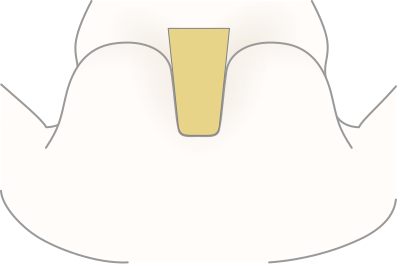 File:Cleavage type (Craniocaudal view) Tumbler Glass small.svg