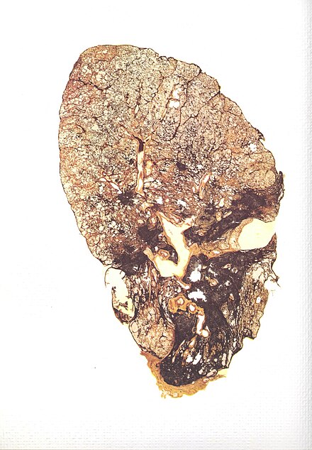 Slice of a lung affected by silicosis
