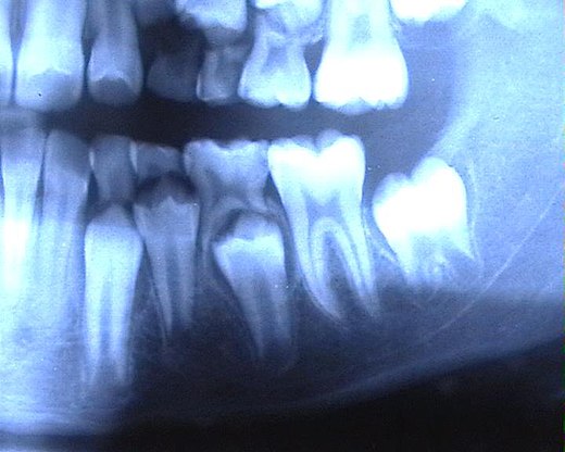 Фотография постоянный. Молочный прикус рентген. Сменный прикус рентген. Рентгеновский снимок челюсти ребенка.