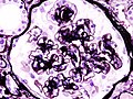 糖尿病性肾小球硬化的肾病综合征之病理组织学图像。PAS染色法。