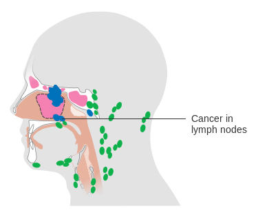 File:Diagram showing ethmoid sinus cancer that has spread to the lymph nodes CRUK 121.svg