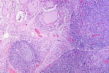 Marked lympocytic infiltration (purple areas) of the thyroid gland in a patient with chronic autoimmune thyroiditis Hashimoto's thyroiditis, HE 3.jpg