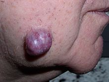 Large, red, exophytic nodule on the malar surface of an adult
