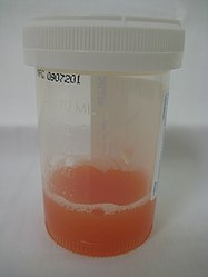 Appearance of synovial fluid from a joint with inflammatory arthritis.