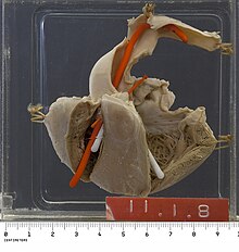 Fallot's tetralogy specimen, from the UCT Pathology Learning Centre PLC Fallots tetralogy.jpg