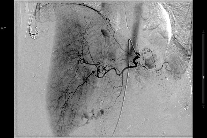 File:Sangrat actiu de l'artèria gastroduodenal.jpg