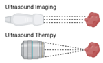صورة مصغرة لـ الموجات فوق الصوتية المركزة لتوصيل الدواء داخل القحف