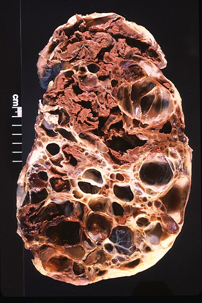 File:Adult Polycystic Kidney.jpg