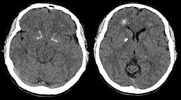Brain computer tomography cuts of the patient with 22q11.2 syndrome, demonstrating basal ganglia and periventricular calcification.jpg