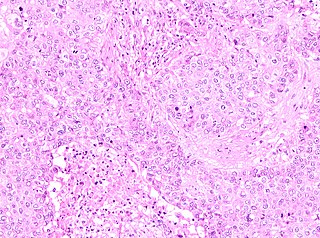 <span class="mw-page-title-main">Pure apocrine carcinoma of the breast</span> Medical condition