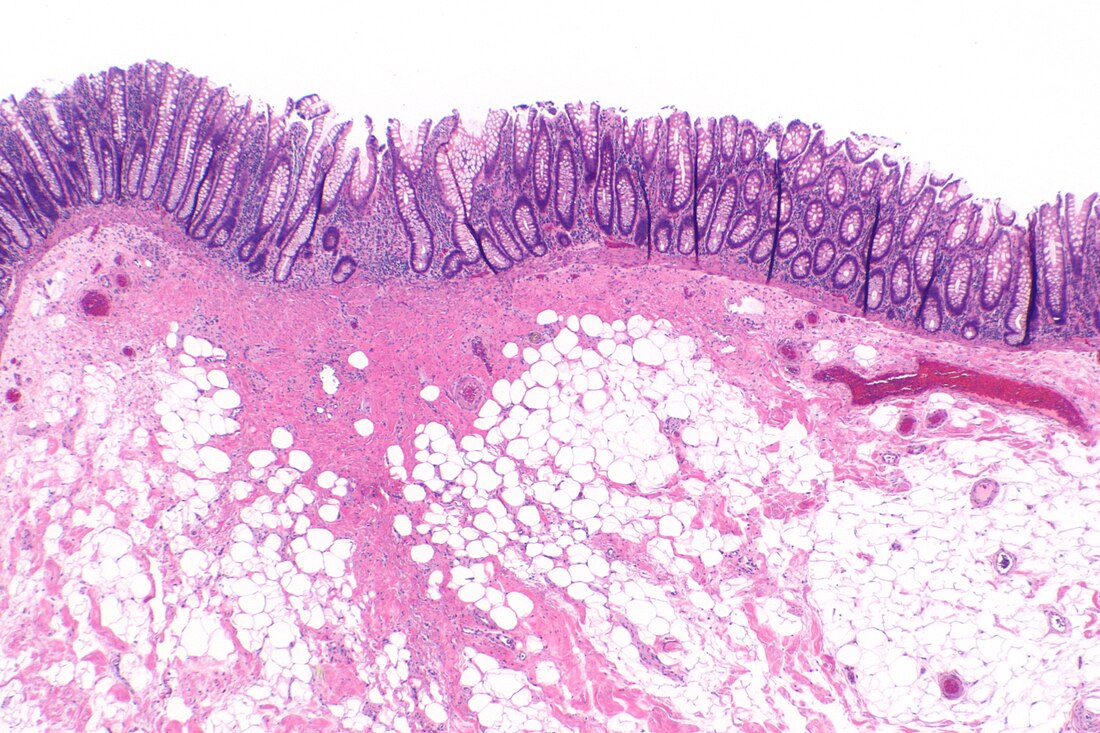 Colonic polypectomy