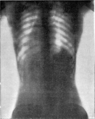 Fig. 25. — Thorax féminin sans corset (cliché Radiguet).