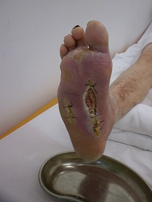 Diabetic foot syndrome.JPG