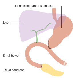 Diagram showing how the pancreas and bowel is joined back together after a Whipple's operation CRUK 140.svg