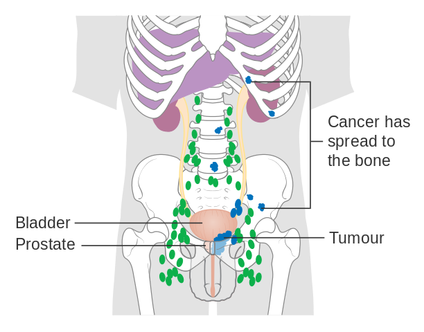 File Diagram Showing Prostate Cancer That Has Spread To