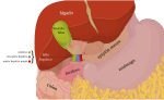 Miniatura para Cáncer de vesícula