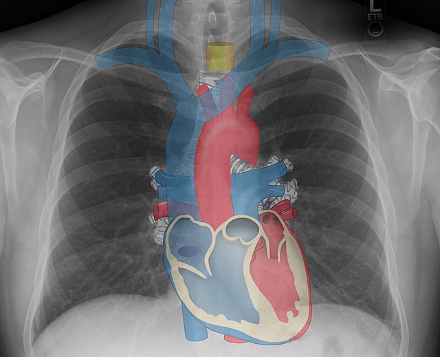 theRadiologist on X: ANATOMY: Chest X-Ray fused with coronal CT showing  mediastinal anatomy  / X