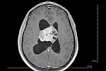 Thumbnail for Central neurocytoma