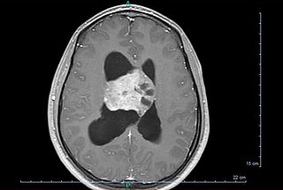 <span class="mw-page-title-main">Central neurocytoma</span> Medical condition