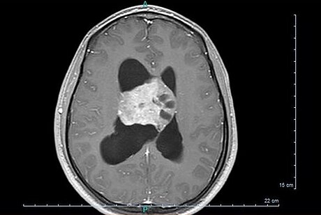 Central neurocytoma