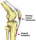 Thumbnail for Sinding-Larsen and Johansson syndrome