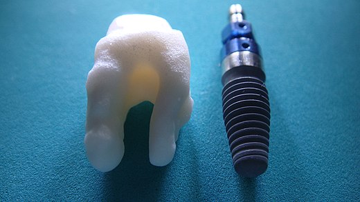 Wortel Analoog Tandimplantaat in vergelijking met conventioneel implantaat