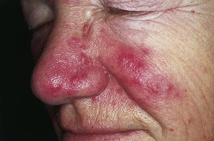 Rosacea over the cheeks and nose