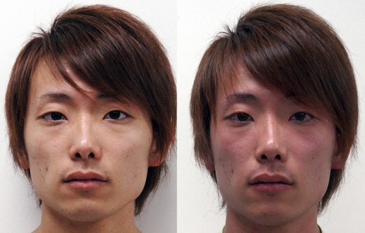 Facial flushing. Before (left) and after (right) drinking alcohol. A 22-year-old East Asian man who is ALDH2 heterozygous showing the reaction.[2]