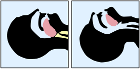 Tongue blocking airway.svg