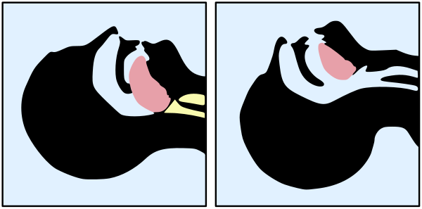 In case of tongue fallen backwards, blocking the airway, it is necessary to hyperextend the head and pull up the chin, so that the tongue lifts and clears the airway.