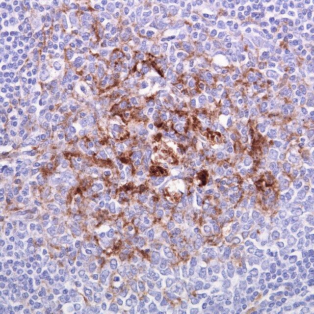 Tonsil biopsy in vCJD, with immunostaining showing prion protein