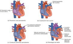 2009 Defecte cardiace congenitale-ro.png