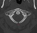 X-ray computed tomography scan of unfused arch at C1